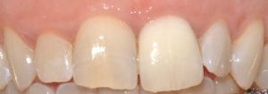 Sbiancamento endodontico
