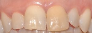 Sbiancamento endodontico